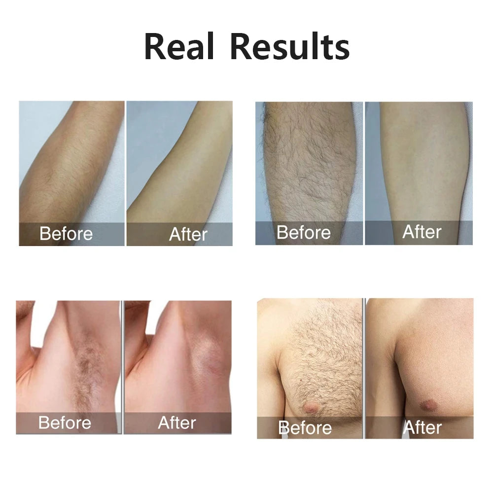 IPL Laser Hair Removal Device