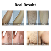 IPL Laser Hair Removal Device