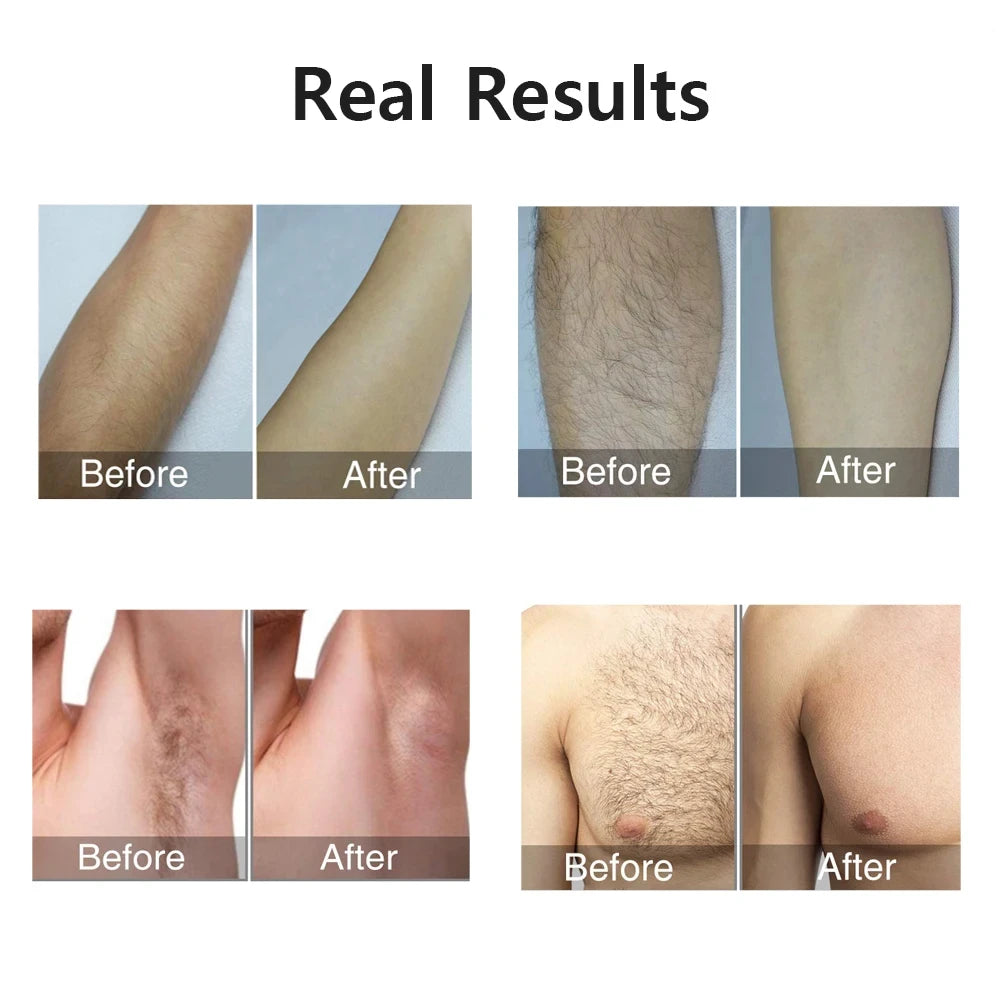 Laser Epilator IPL Hair Removal 990000 Flashes