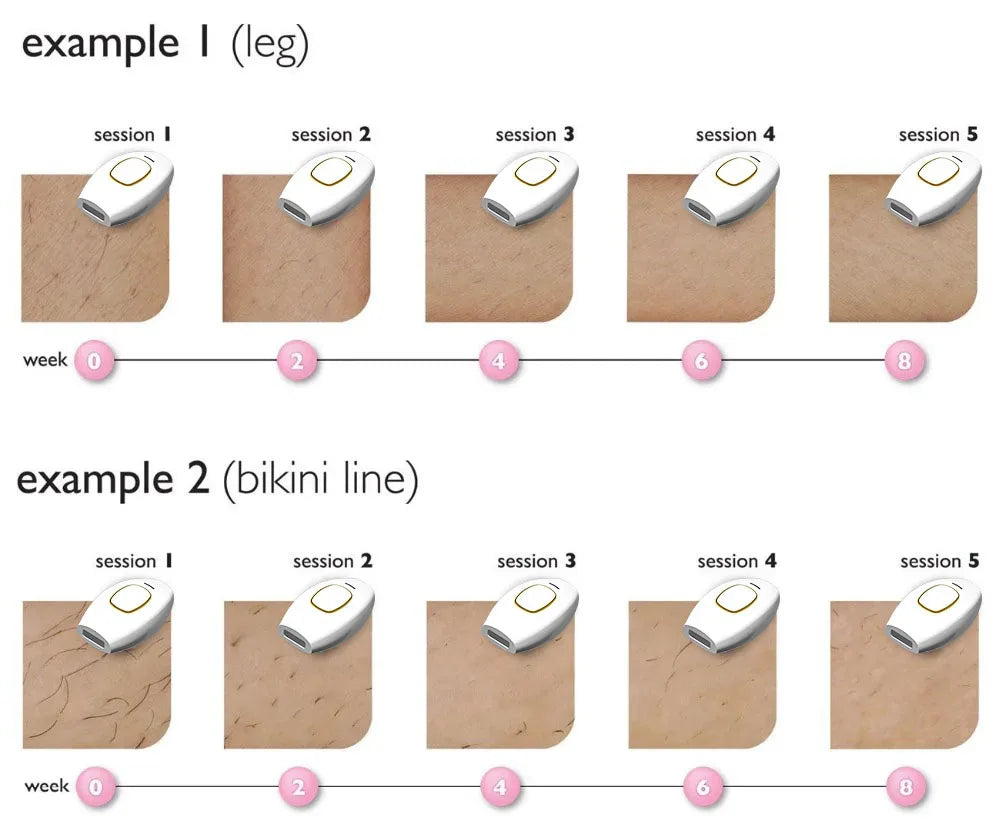 IPL Laser Hair Removal Device