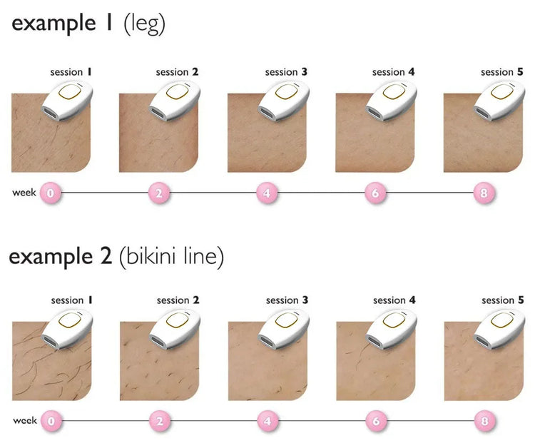 IPL Laser Hair Removal Device