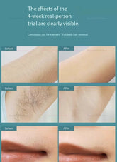 IPL Laser Hair Removal Device